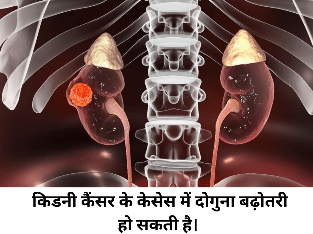 Kidney Cancer Cases to Double By 2050