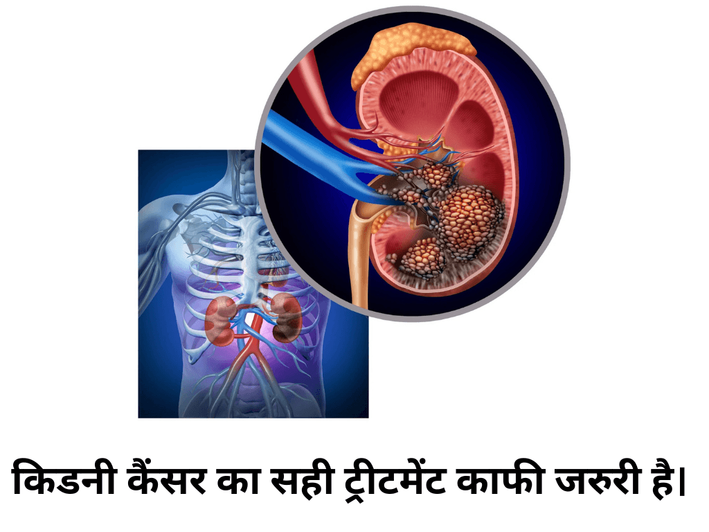 Kidney Cancer Cases to Double By 2050